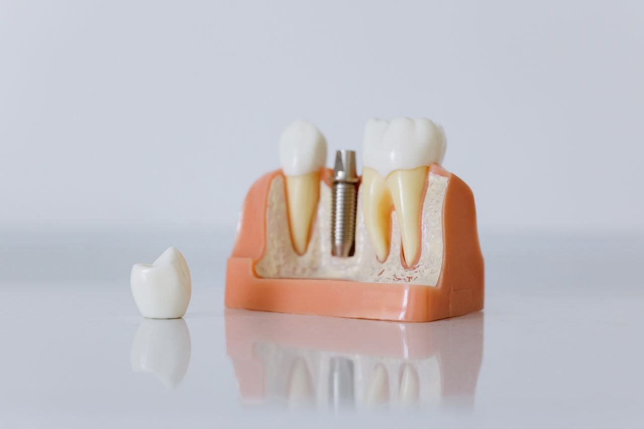 Close-up of a dental implant model