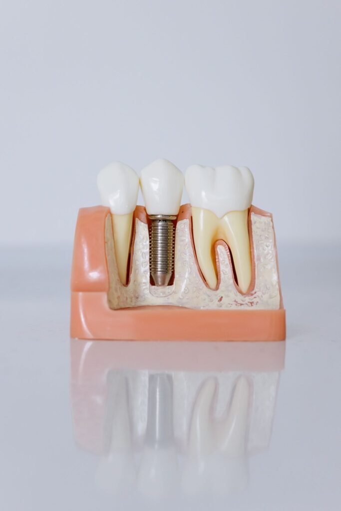 Close-up model of a dental implant with crown and surrounding gum in Aurora