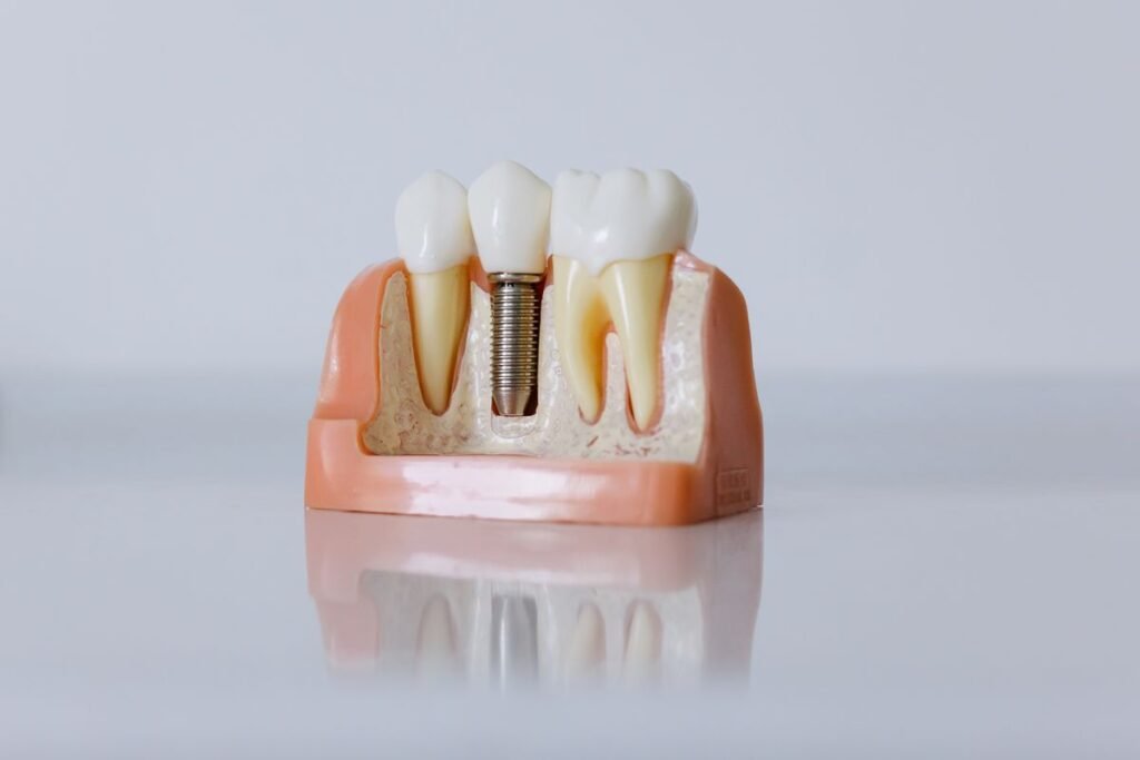 Dental implant model showing how a missing tooth is replaced