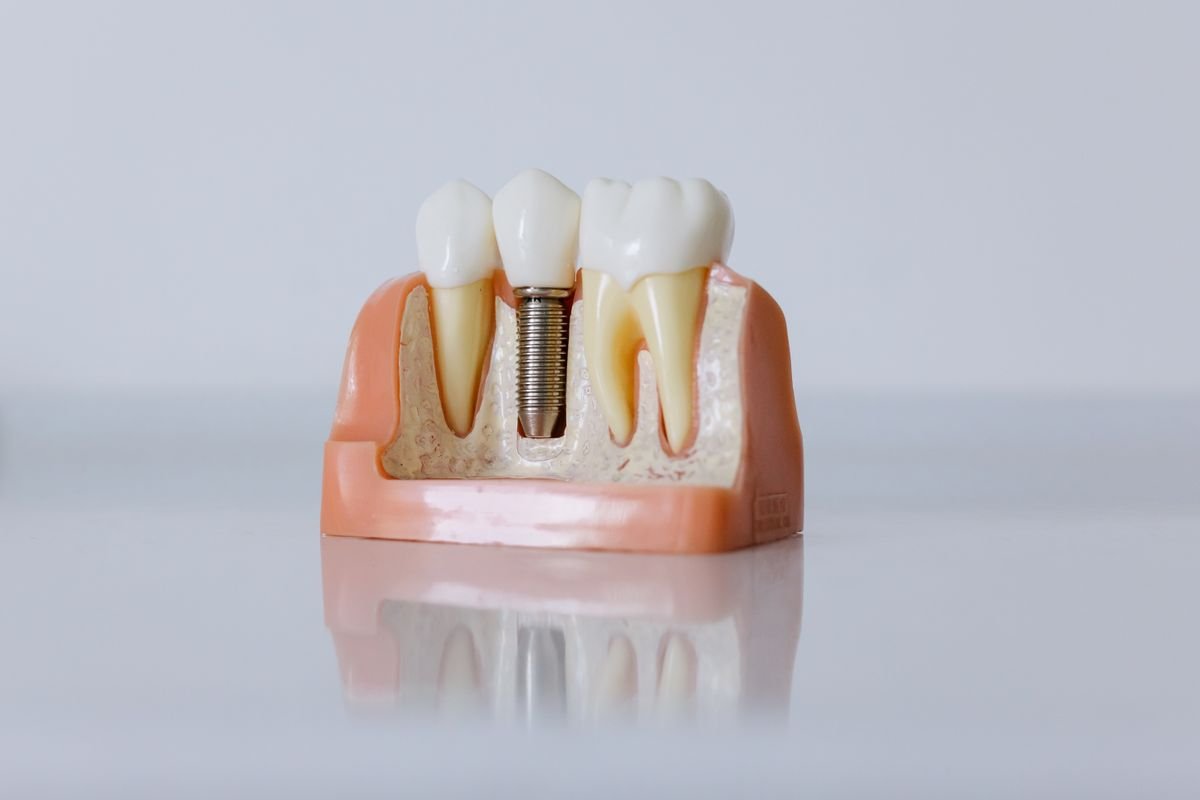 Dental implant model showing how a missing tooth is replaced