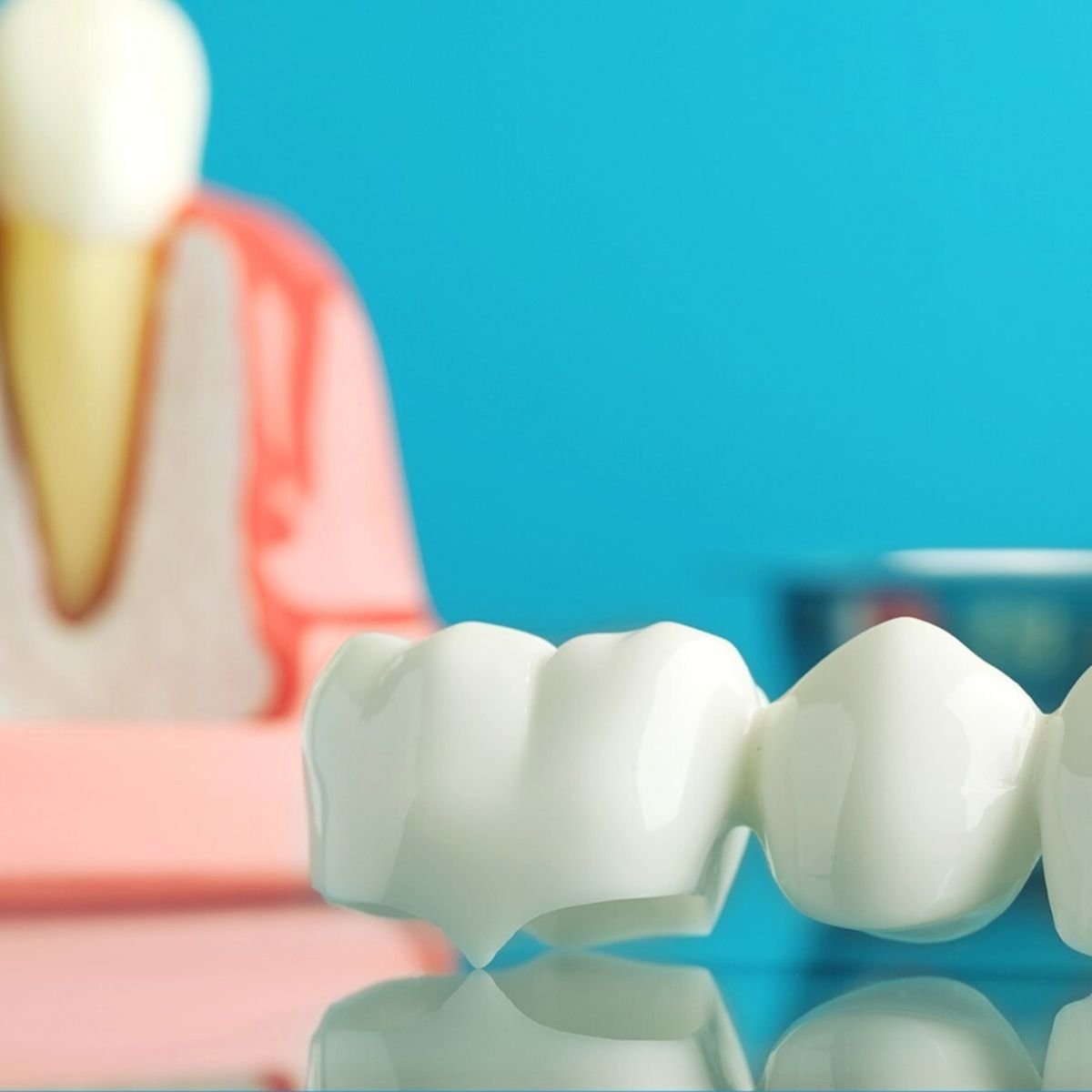 Close-up of a dental crown restoration